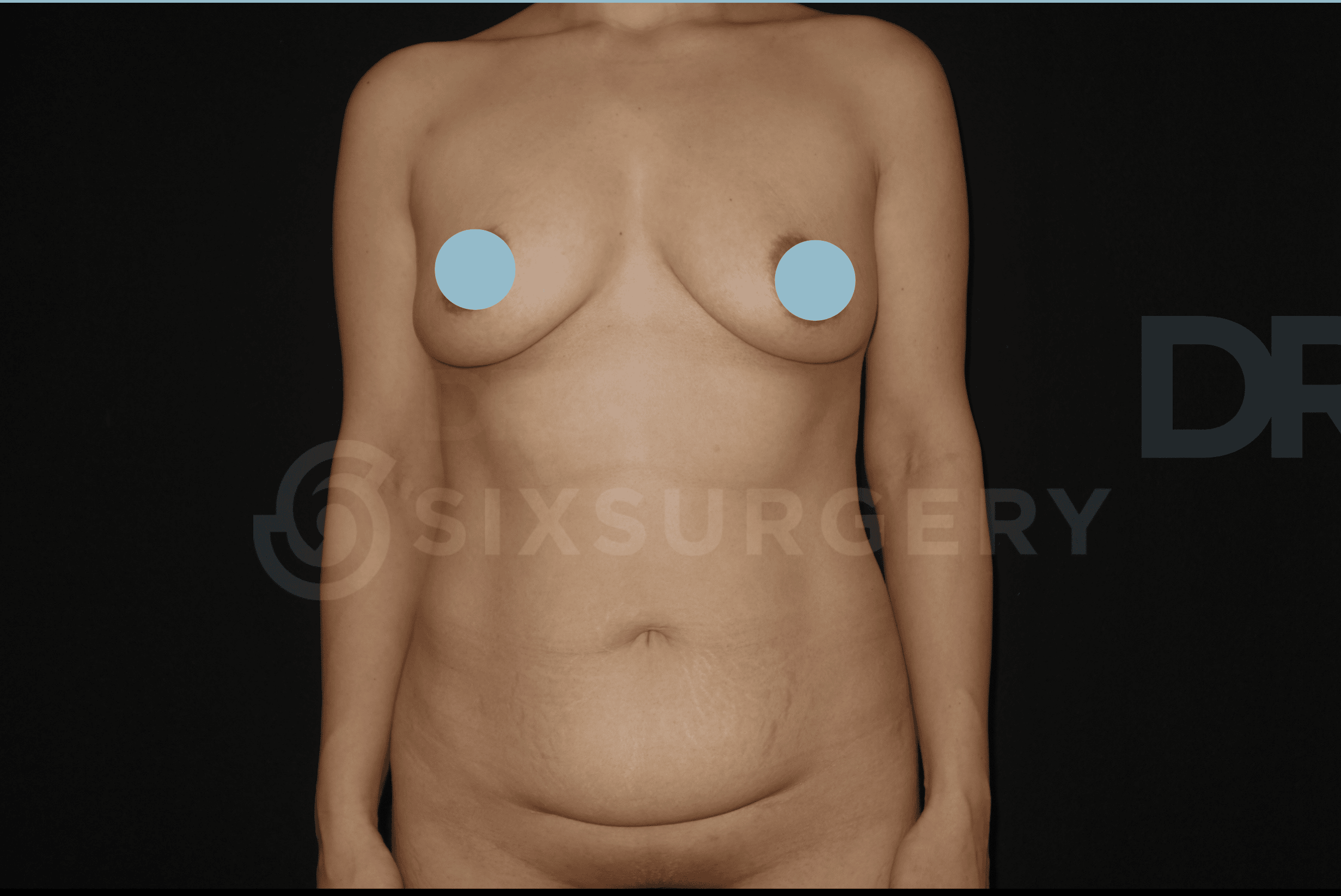 sixsurgery clinic toronto mommy makeover breast augmentation tummy tuck abdominoplasty before and after