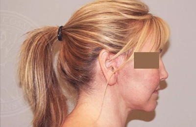 sixsurgery toronto facelift before and after