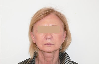sixsurgery toronto facelift before and after