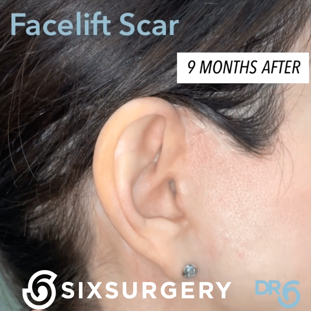 facelift scar 9 months later