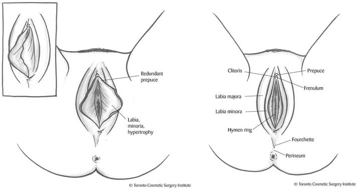 Sixsurgery labiaplasty surgical techniques