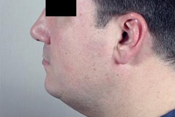 sixsurgery toronto male neck liposuction before and after