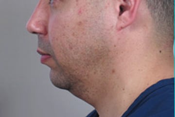 sixsurgery toronto male neck liposuction before and after