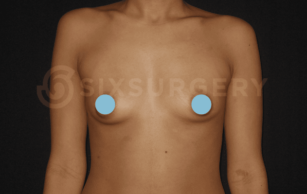 sixsurgery clinic toronto breast augmentation implants before and after