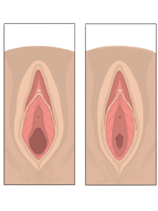 vaginoplasty vaginal tightening