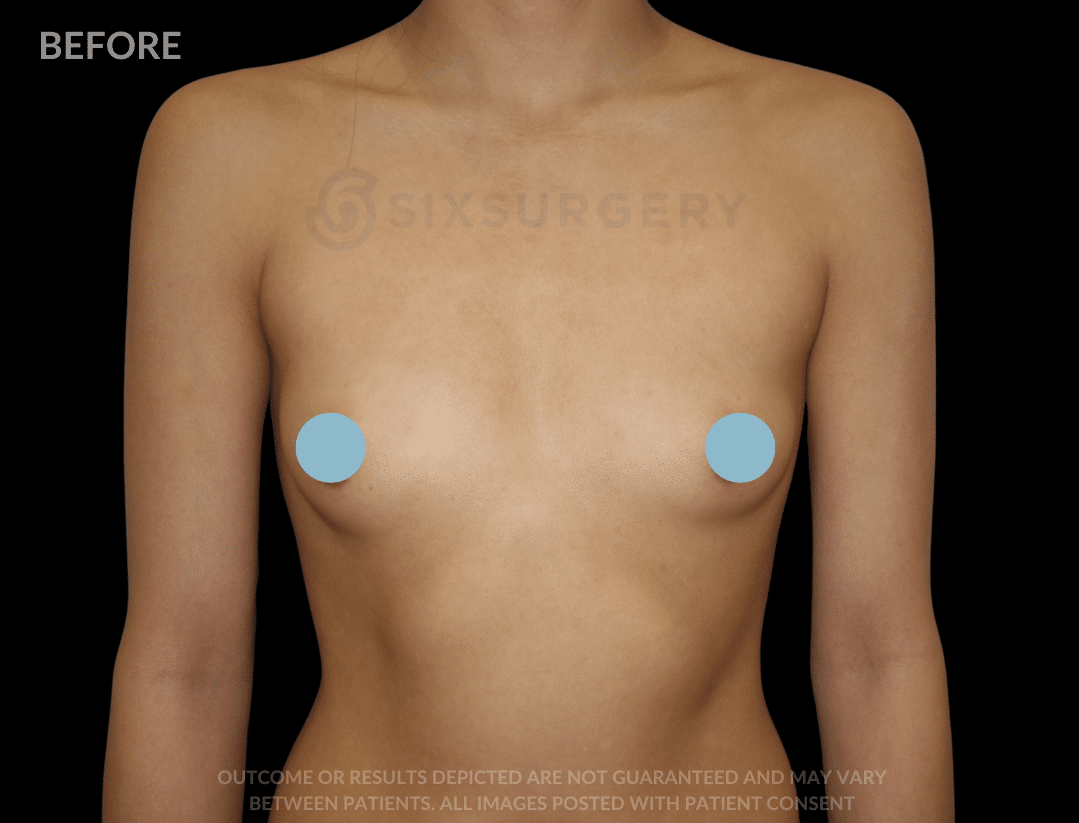 before and after breast augmentation natural look areola incision - six surgery - toronto