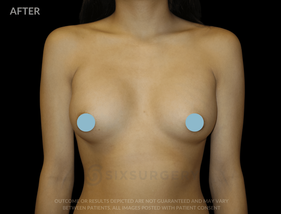 before and after breast augmentation natural look areola incision - six surgery - toronto