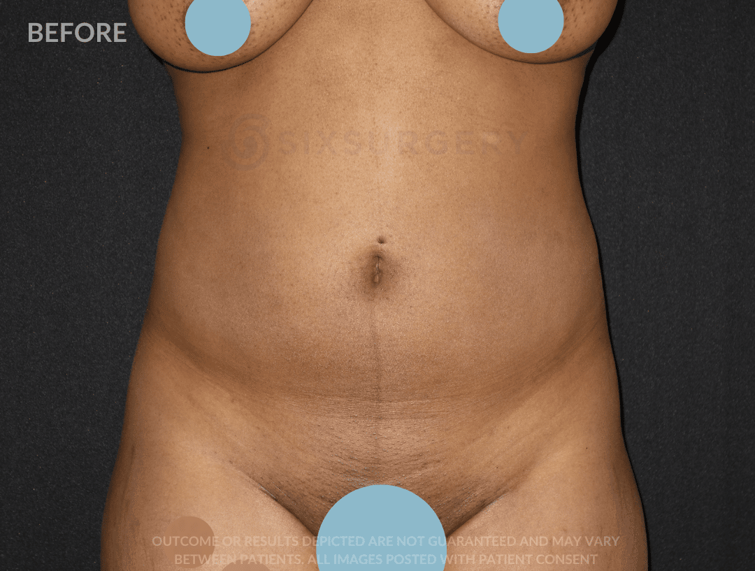 sixsurgery brazilian butt lift before and after