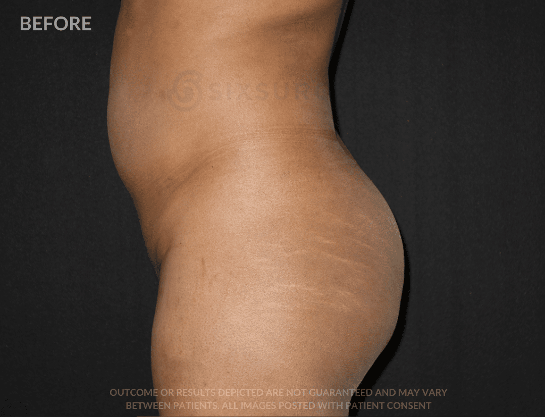 sixsurgery Brazilian Butt lift before and after