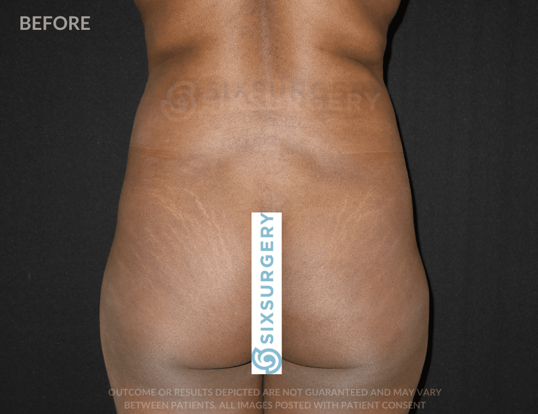 sixsurgery brazilian butt lift before and after