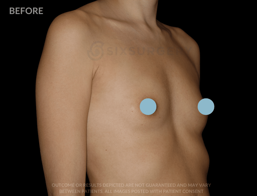 breast augmentation before and after - six surgery - toronto