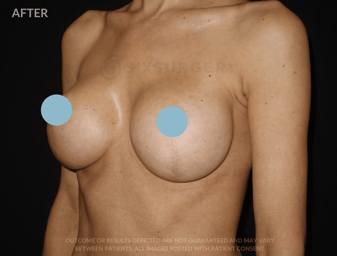 Six surgery Breast Augmentation breast lift before and after