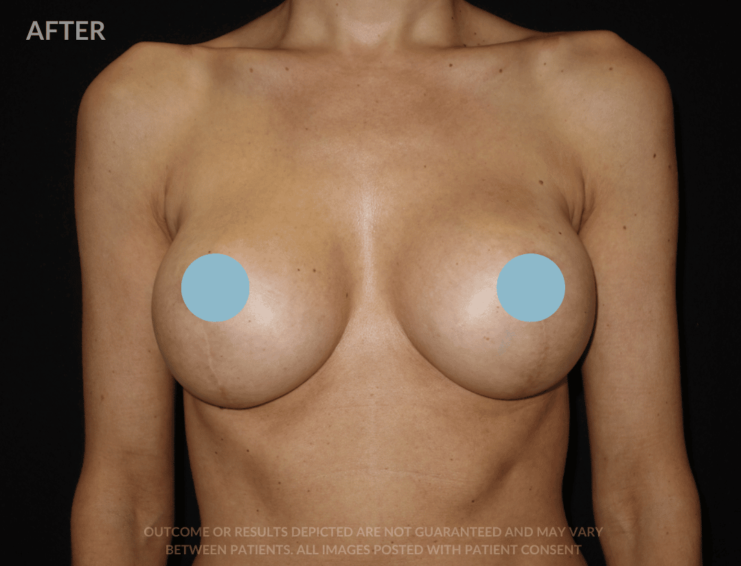 Six surgery Breast Augmentation breast lift before and after