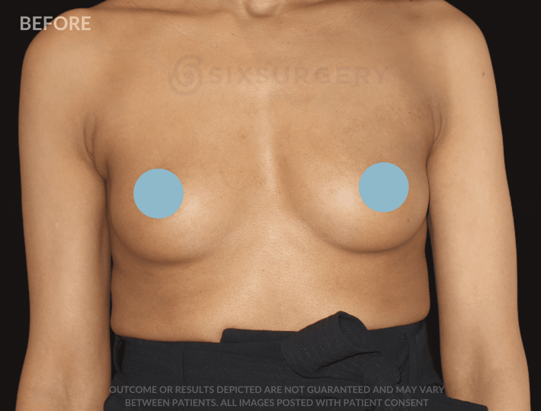 Six surgery Breast Augmentation before and after