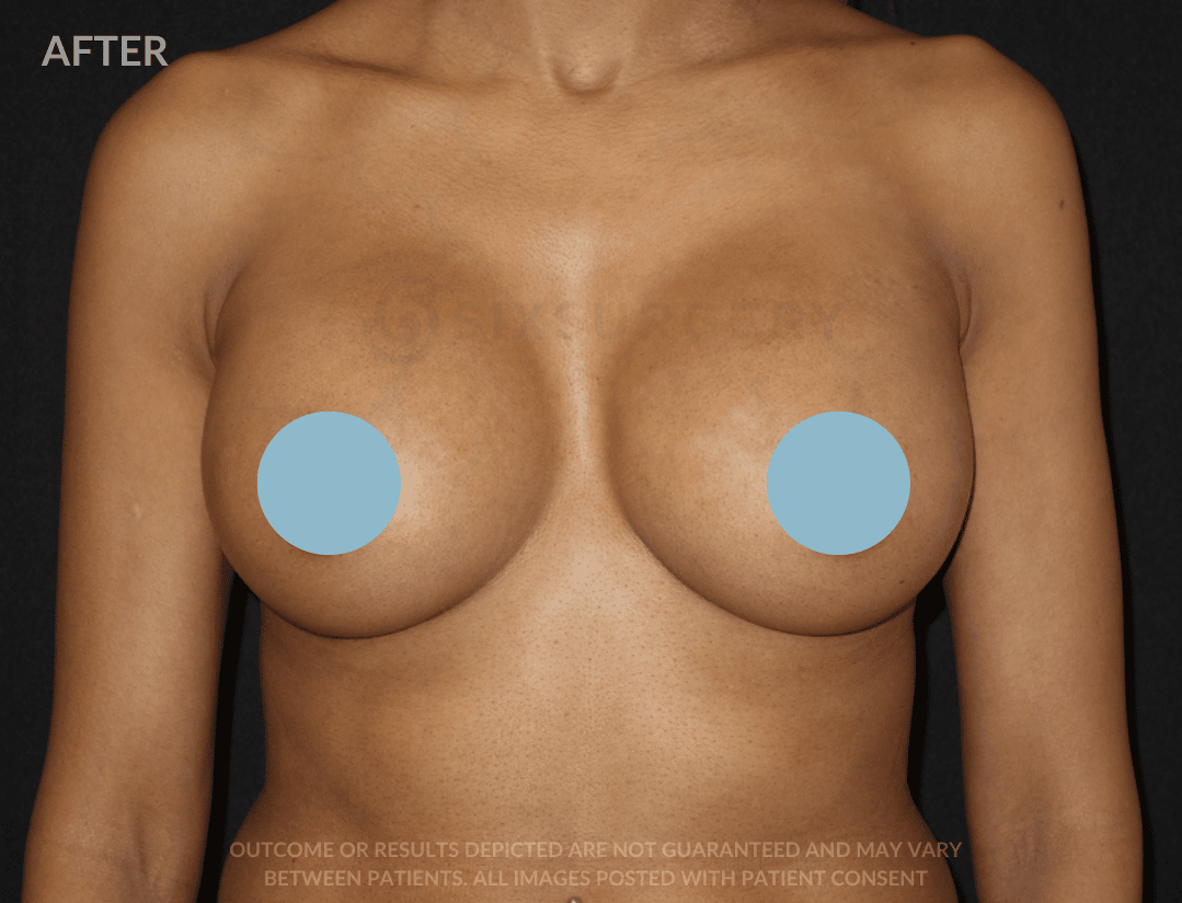 Six surgery Breast Augmentation before and after
