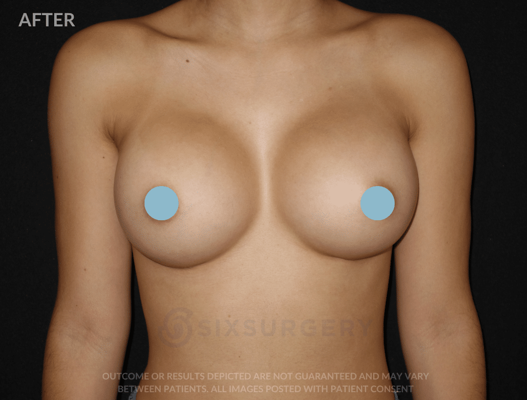 breast augmentation before and after six surgery toronto