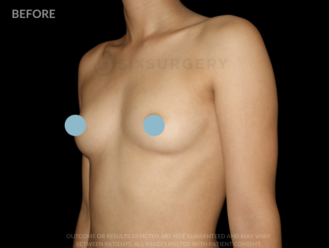breast augmentation before and after six surgery toronto