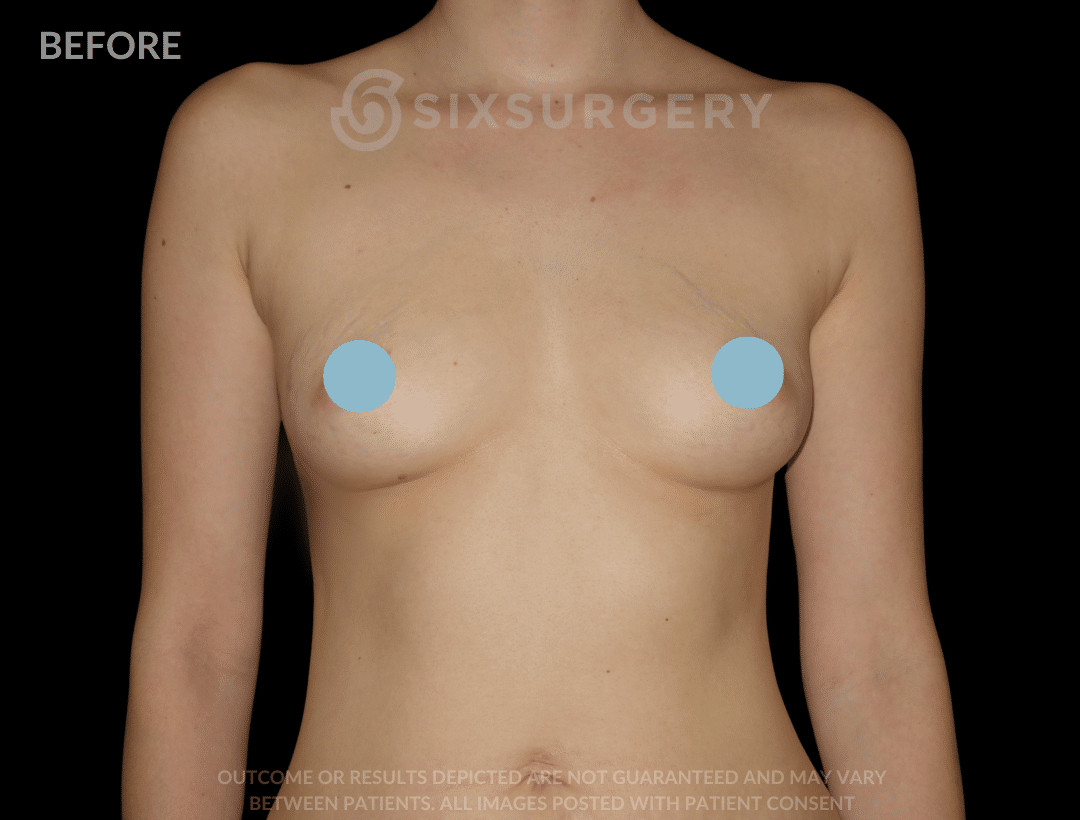 before and after breast augmentation - six surgery - toronto - Dr 6ix