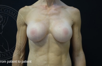 sixsurgery breast augmentation before and after