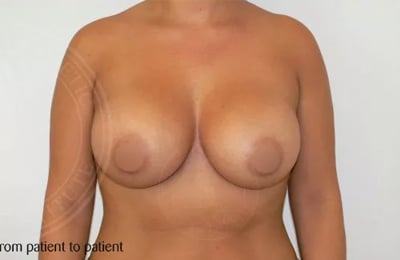 sixsurgery toronto breast implants augmentation before and after