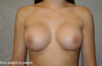 sixsurgery toronto breast implants augmentation before and after