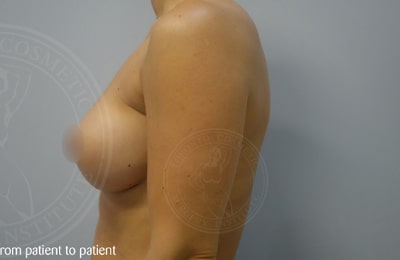 Breast Reduction Gallery