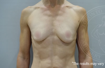 sixsurgery breast augmentation before and after