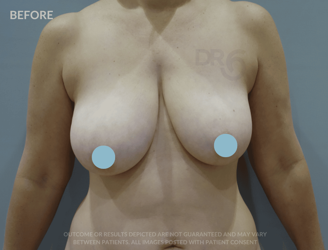 sixsurgery breast lift before and after