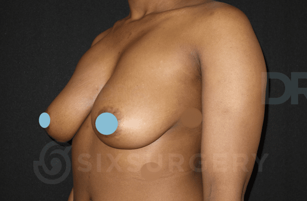 sixsurgery clinic toronto breast augmentation implants inframammary IMF before and after