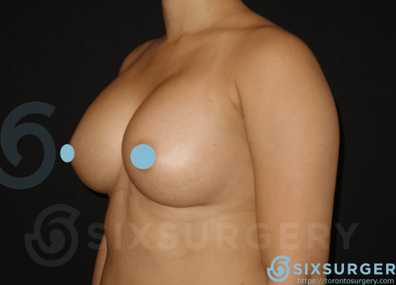sixsurgery clinic toronto breast augmentation implants before and after