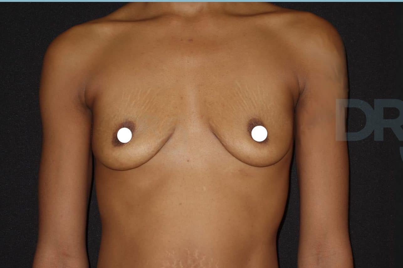 sixsurgery toronto breast augmentation before and after