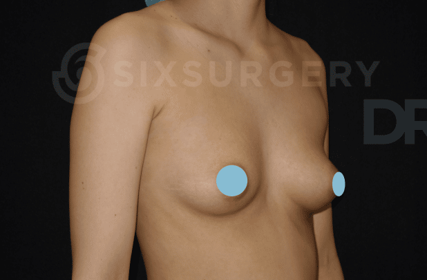 sixsurgery clinic toronto breast augmentation implants transax before and after