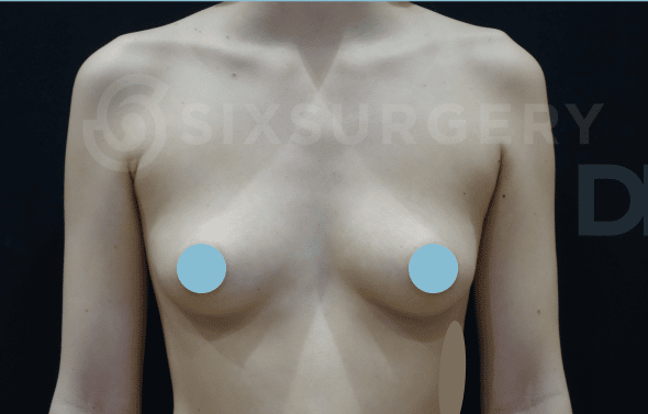 sixsurgery clinic toronto breast augmentation implants transax armpit before and after