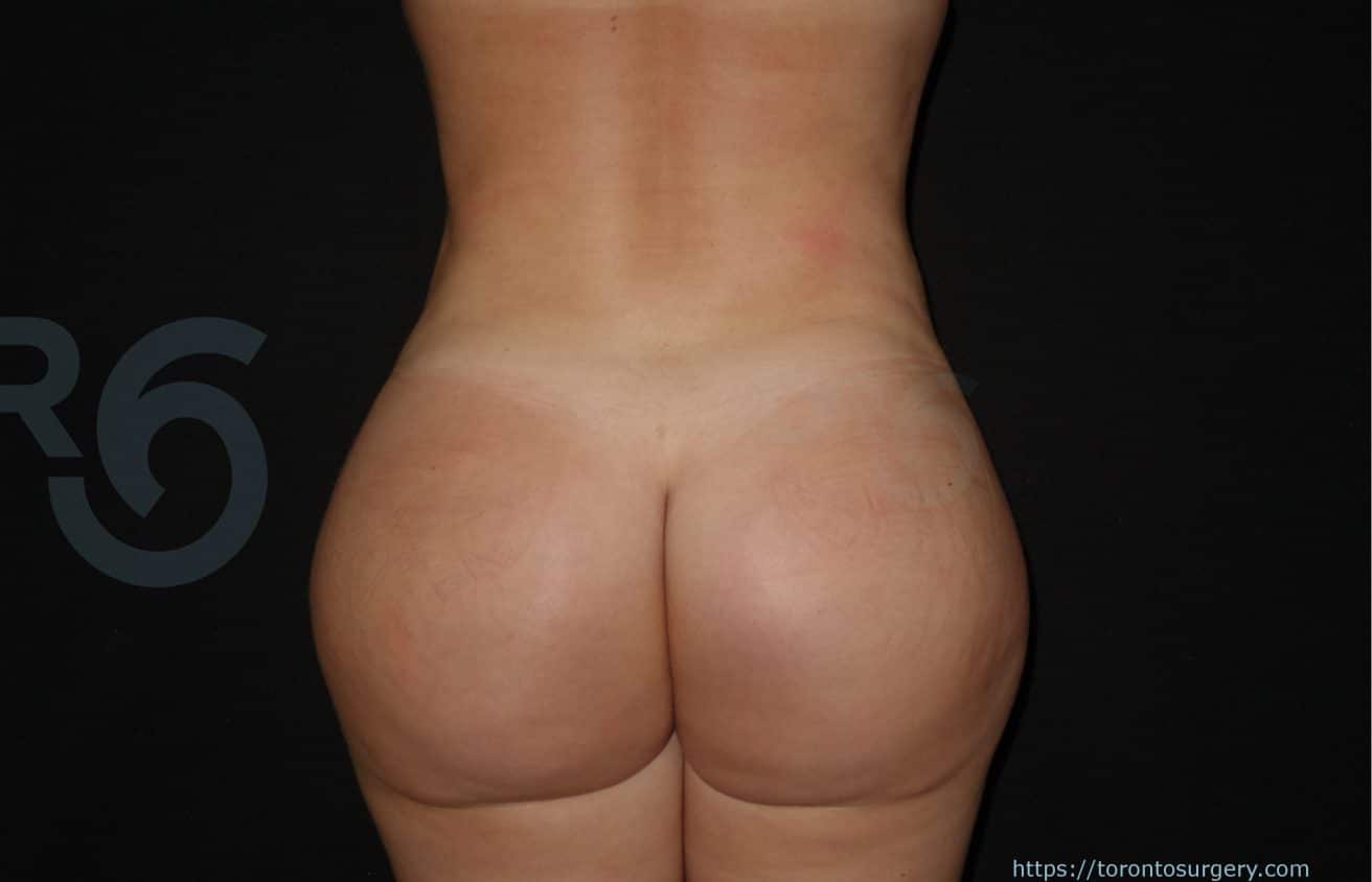 sixsurgery toronto brazilian butt lift bbl before and after