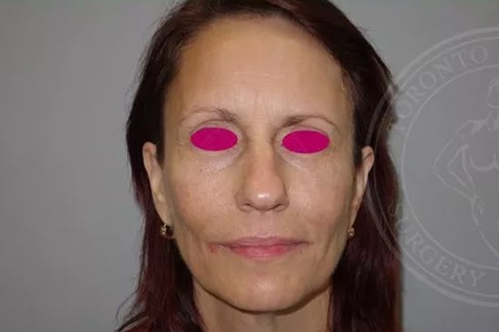 sixsurgery toronto eyebrow lift before and after