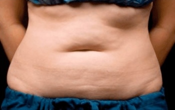 sixsurgery toronto lower abdomen coolsculpting before and after