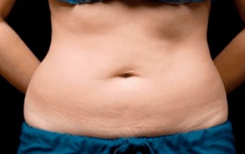sixsurgery toronto lower abdomen coolsculpting before and after