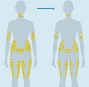 Fat Cells After Typical Weight Loss