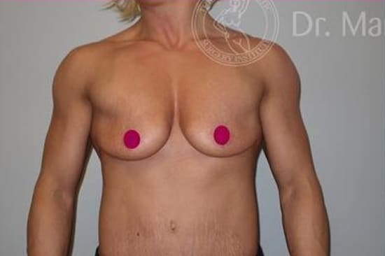 breast augmentation implants on bodybuilder before and after