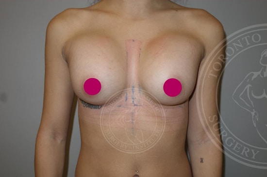 Implants Settling Breast Augmentation Before