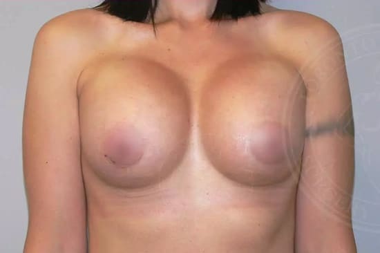 frankenboob breast implants sitting too high