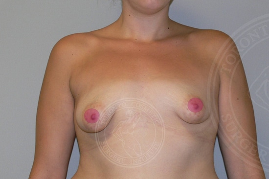 sixsurgery toronto breast lift asymmetry correction with implants before and after