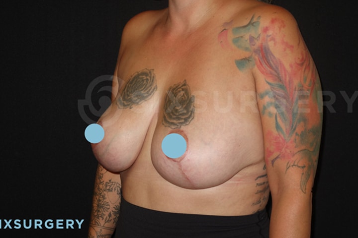 Dr Catherine Haywood toronto breast lift mastopexy with implants before and after