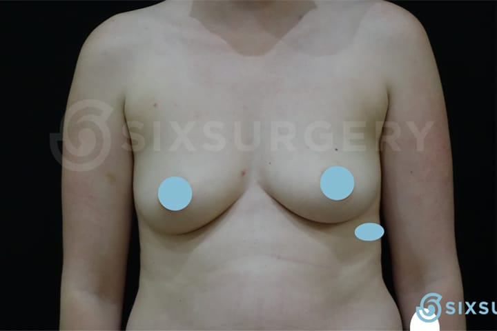 Dr Catherine Haywood toronto breast augmentation implants before and after