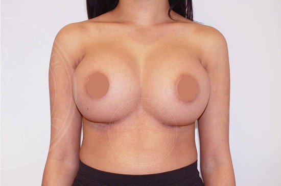 Fake Look Breast Augmentation