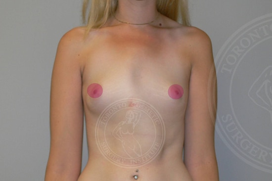 sixsurgery toronto breast lift asymmetry correction with implants before and after