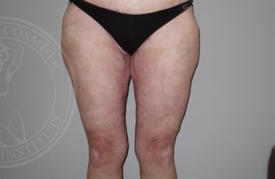 sixsurgery toronto thigh lift before and after