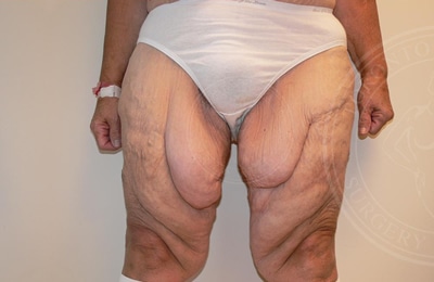 Thigh Lift Gallery