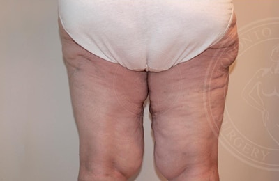 sixsurgery toronto thigh lift before and after
