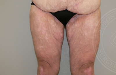 Thigh Lift Gallery